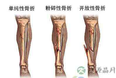 骨外固定器治疗严重胫骨骨折