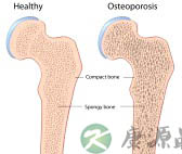 低钙血症是怎么回事