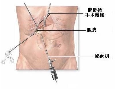 胆囊息肉警惕过度治疗 合理治疗是关键！