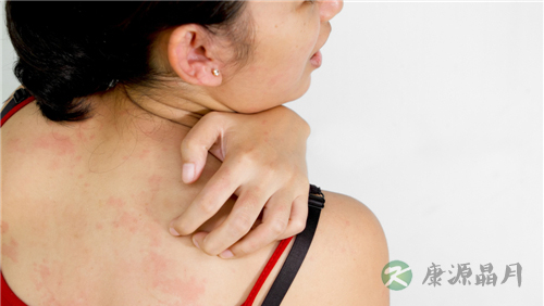 大疱性多形红斑怎么治疗 大疱性多形红斑怎么治疗