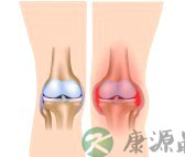 反应性关节炎怎么治疗 反应性关节炎怎么治疗