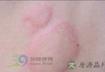 六道防线对付荨麻疹