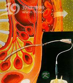 治肾病，肾透析应尽早进行