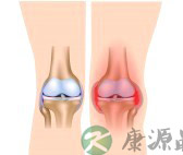 反应性关节炎能治愈吗