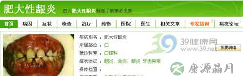 综合认识牙龈炎