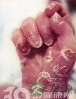 惊叹：孩子也会有性病