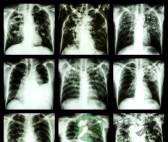 肺结核会传染吗 肺结核会传染吗