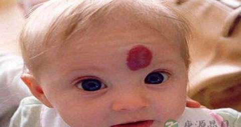 血管痣是什么原因