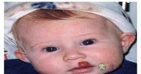 血管痣是什么原因