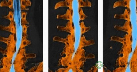 椎管狭窄的症状