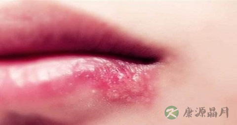 口角生疮吃什么药
