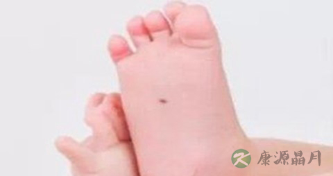 血管痣吃什么药
