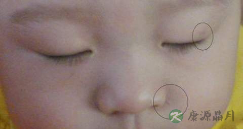 疤痕增生吃什么药