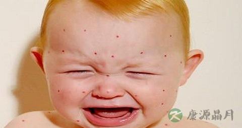 虫咬性皮炎不能吃什么，虫咬性皮炎的注意事项