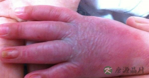 烧伤不能吃什么，烧伤的注意事项