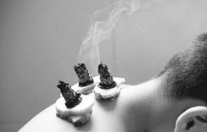 三伏灸有哪些注意事项