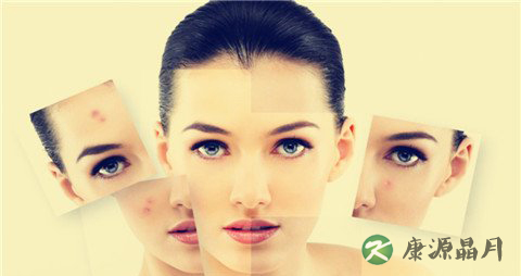 夏季预防青春痘的方法