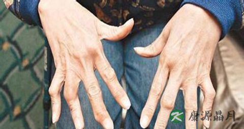 类风湿冬天吃什么好