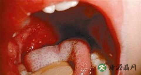 喉咙疱疹是怎么回事