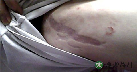 股癣最佳治疗方法