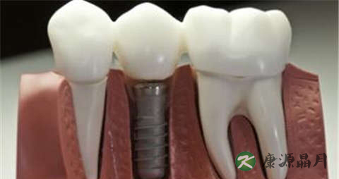 种植牙的危害