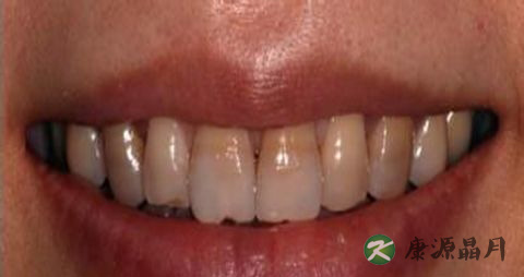 牙黄怎么快速变白