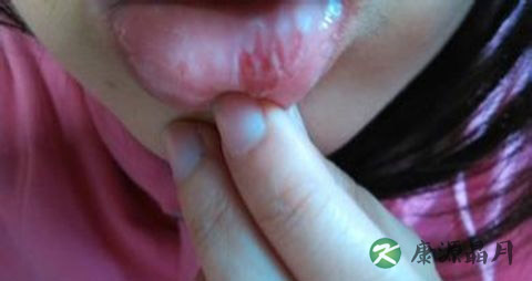 口疮怎么治 口疮怎么治