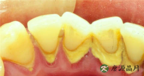 怎样去除牙结石