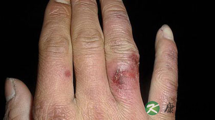 冬天手冻了怎么办