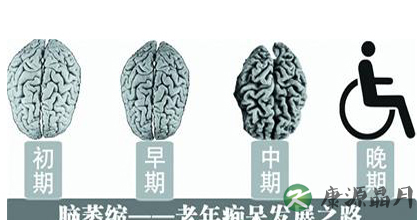 脑萎缩的症状及其治疗方法
