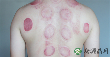 拔罐的颜色可以看出病症吗 拔罐的颜色可以看出病症吗