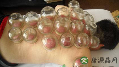 中医拔罐减肥有效吗