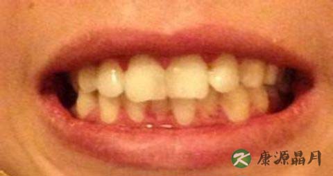 牙黄怎么快速变白