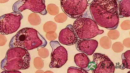 白血病是怎么引起的