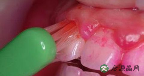 刷牙时牙龈出血是怎么回事