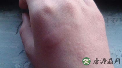 荨麻疹的危害是什么