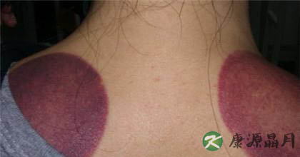 拔罐的颜色可以看出病症吗 拔罐的颜色可以看出病症吗