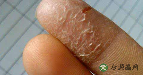 冬天手脱皮是什么原因 冬天手脱皮是什么原因