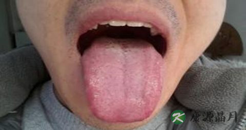 齿痕舌怎么调理