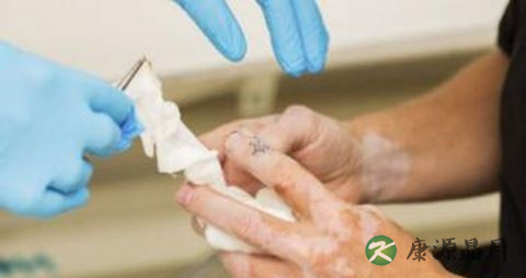 白癜风应该怎样治疗