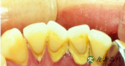 刷牙时牙龈出血是怎么回事