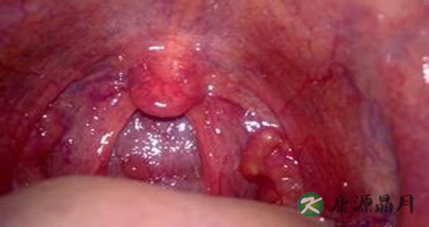 喉咙里总有痰怎么办