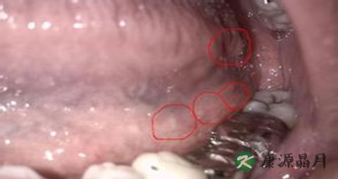 治疗口腔溃疡方法