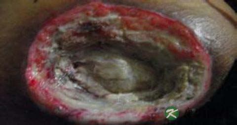 褥疮的治疗方法