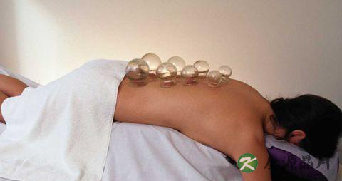 白领拔罐有助缓解后背疼痛