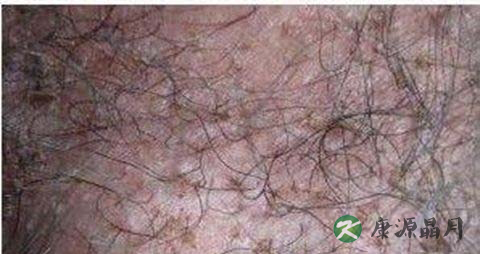 毛囊炎会自愈吗