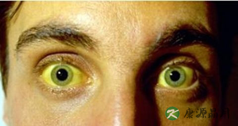 黄疸的病因分类