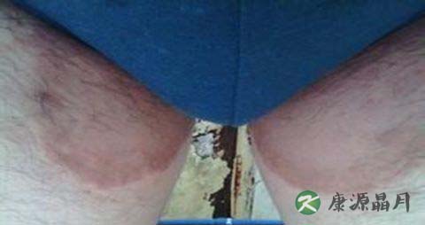 股癣最佳治疗方法