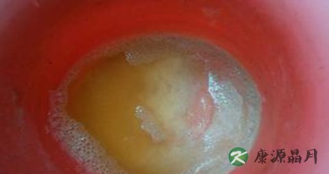 尿液发黄是怎么回事