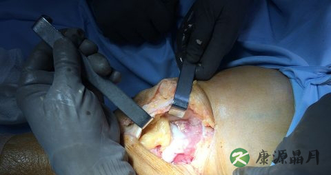 无痛人流后头晕恶心怎么回事 无痛人流后头晕恶心怎么回事